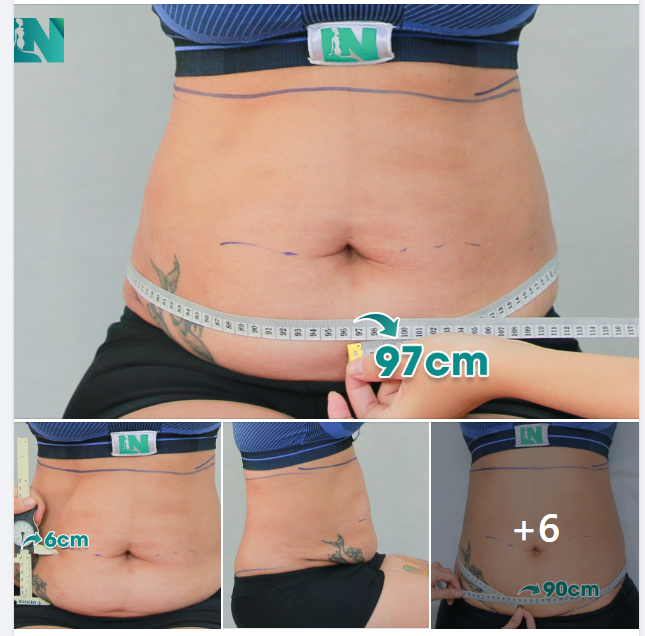 HÚT MỠ TẠO DÁNG THẨM MỸ CHO CHỊ KH 49 TUỔI ĐẾN TỪ ĐỒNG NAI, LO LẮNG HÚT MỠ ĐỂ LẠI SẸO. TRỰC TIẾP 15H00 – 15H30 HÔM NAY