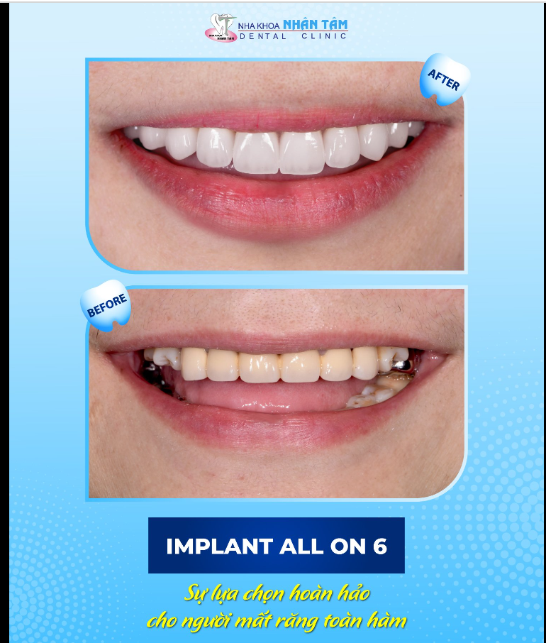 IMPLANT ALL ON 6 – SỰ LỰA CHỌN HOÀN HẢO CHO NGƯỜI MẤT RĂNG TOÀN HÀM