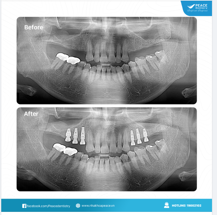 Implant vùi sâu trong xương, đều và thẳng theo cách tối ưu nhất...đó là những cơ sở lý tưởng để những chiếc "răng implant" vững chắc, ổn định, đáp ứng cao nhất chức năng ăn nhai, chức năng thẩm mỹ và sử dụng trọn đời.