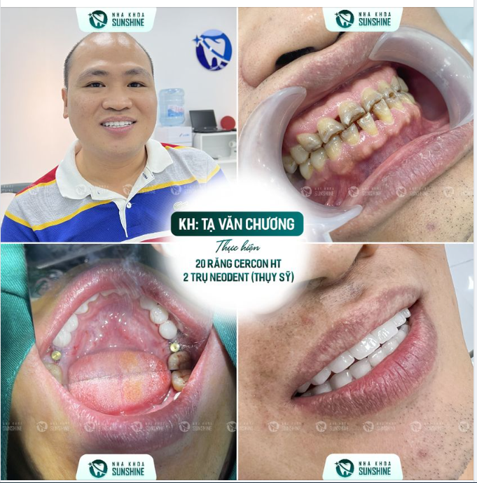KẾT HỢP PHƯƠNG PHÁP BỌC RĂNG SỨ THẨM MỸ VÀ TRỒNG IMPLANT