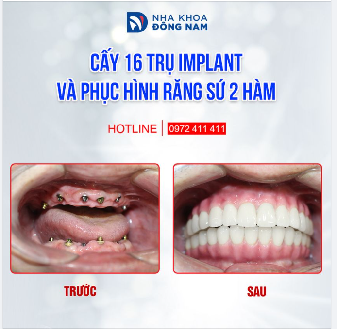 KẾT QUẢ CẤY IMPLANT 2 HÀM TRÊN CẢ SỰ MONG ĐỢI CỦA BỆNH NHÂN