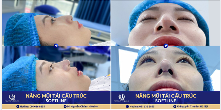 Kết quả chỉnh sửa MŨI BẤT THƯỜNG TRỞ VỀ BÌNH THƯỜNG cho nàng điều dưỡng