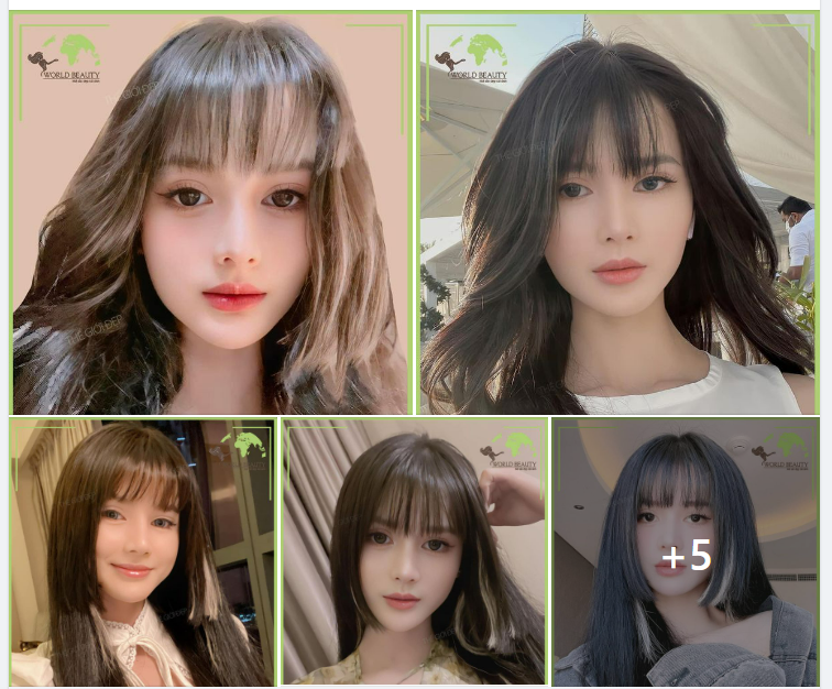 Kết quả mỹ mãn cho quý Cô nhờ giải pháp n.âng mũi cấu trúc bằng sụn tự thân kết hợp thanh Surgiform