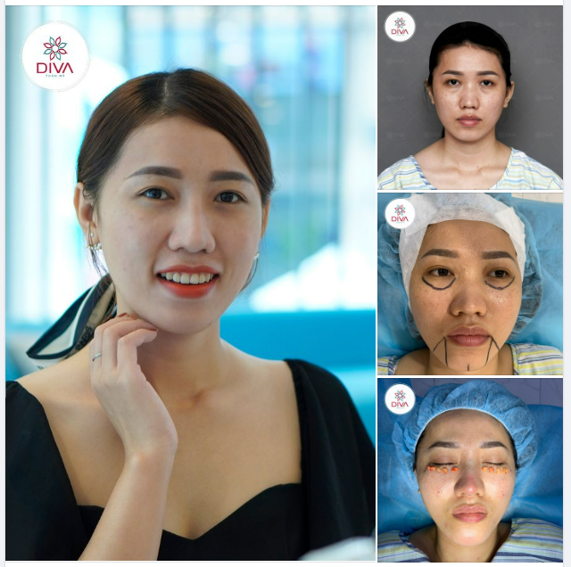 KẾT QUẢ NÂNG MŨI, LẤY MỠ MÍ DƯỚI, CẤY MỠ SAU 3 TUẦN CÓ GÌ KHÁC BIỆT