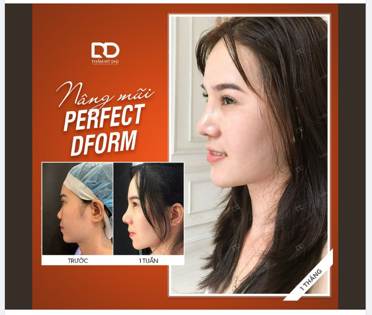KẾT QUẢ NÂNG MŨI PERFECT DFORM SAU 1 THÁNG