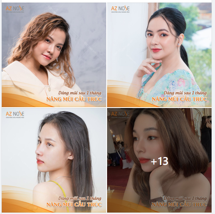KẾT QUẢ SAU 1 THÁNG NÂNG MŨI CẤU TRÚC