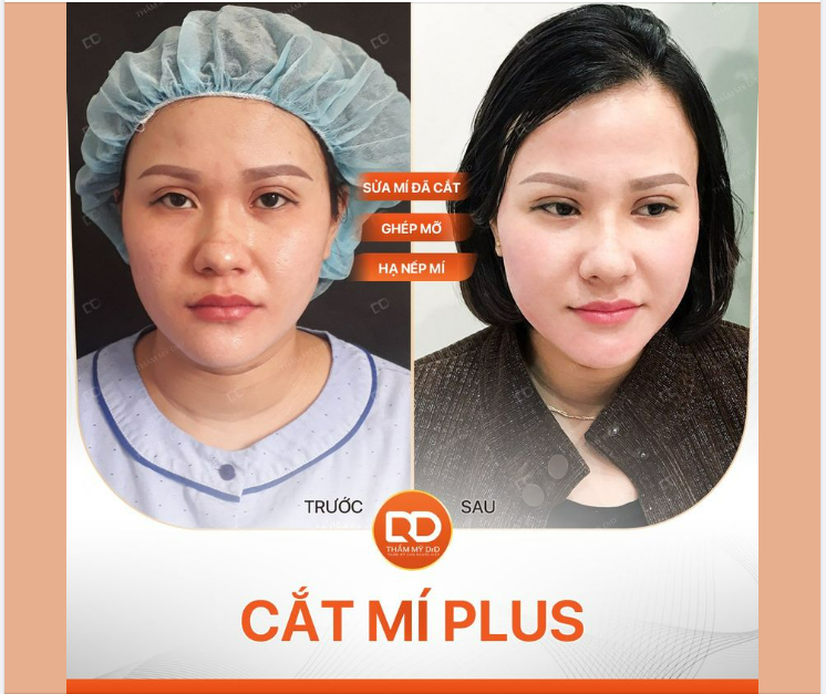 KẾT QUẢ SAU 1 TUẦN THỰC HIỆN CẮT MÍ PLUS