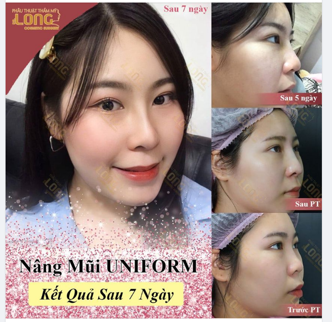 KẾT QUẢ SAU 7 NGÀY NÂNG MŨI MŨI ĐẸP NHƯ Ý - CHÍ PHÍ HỢP LÝ - NHẬN NGAY ƯU ĐÃI 15%