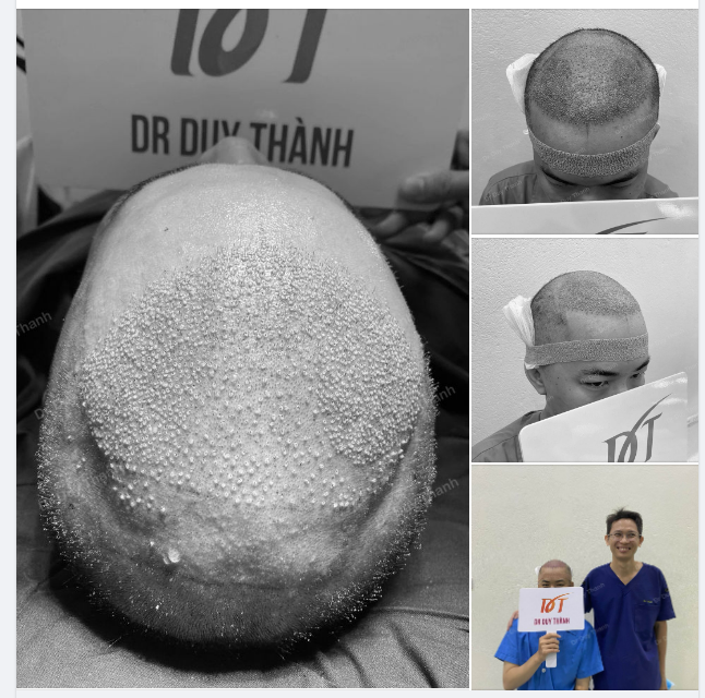 KẾT QUẢ SAU CẤY 1900 NANG TÓC CHO BOY VŨNG TÀU 28 TUỔI