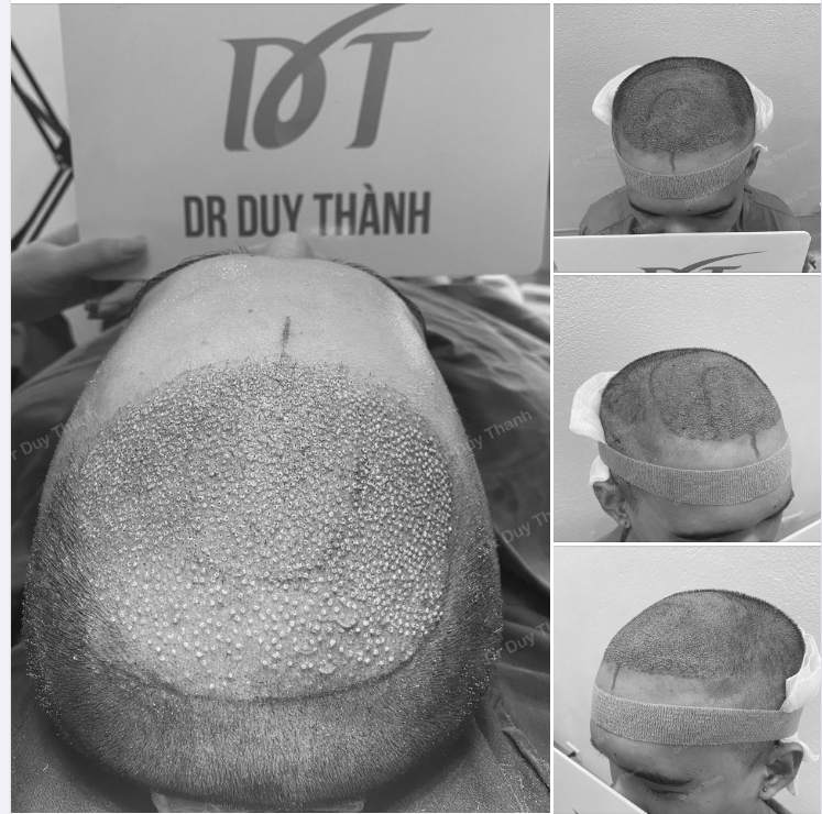 KẾT QUẢ SAU CẤY 1950 NANG TÓC BOY HCM