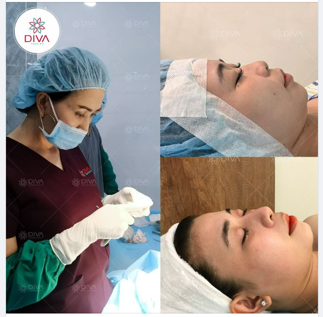 KẾT QUẢ SAU NÂNG MŨI, CẮT CÁNH MŨI
