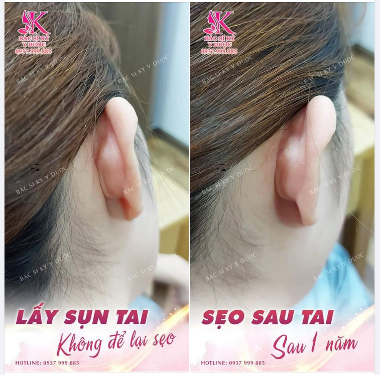 KẾT QUẢ SẸO SAU TAI KHI NÂNG MŨI 1 NĂM.
