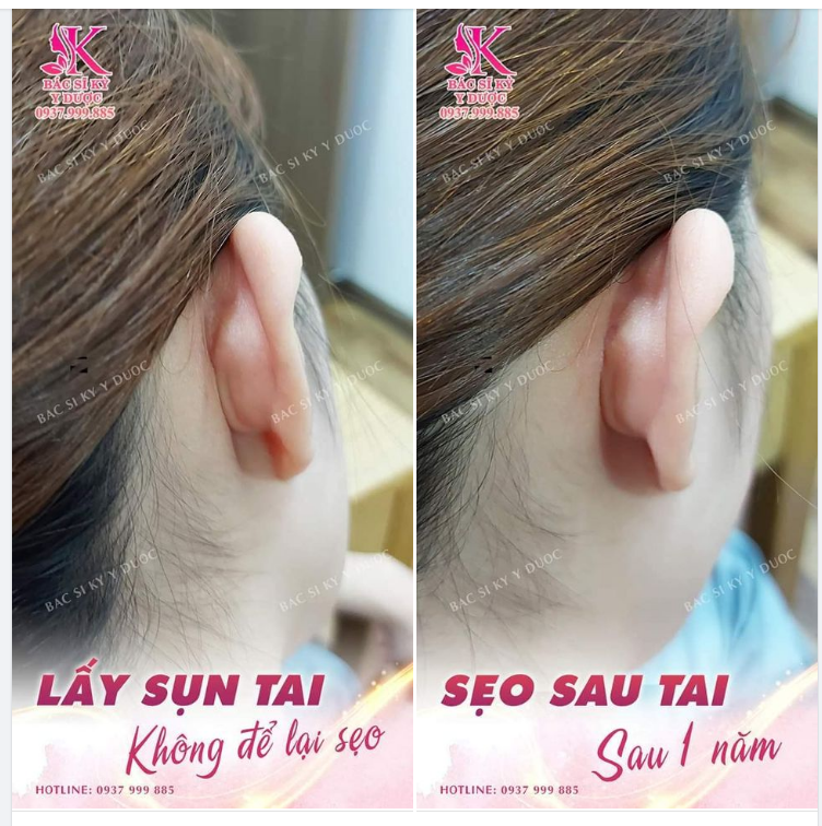 KẾT QUẢ SẸO SAU TAI KHI NÂNG MŨI 1 NĂM.