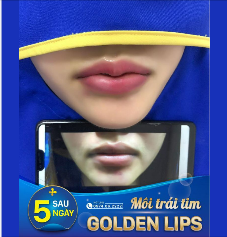 KẾT QUẢ TẠO HÌNH MÔI GOLDEN LIPS = Sở hữu ngay bờ môi trái tim mềm mại, quyến rũ.
