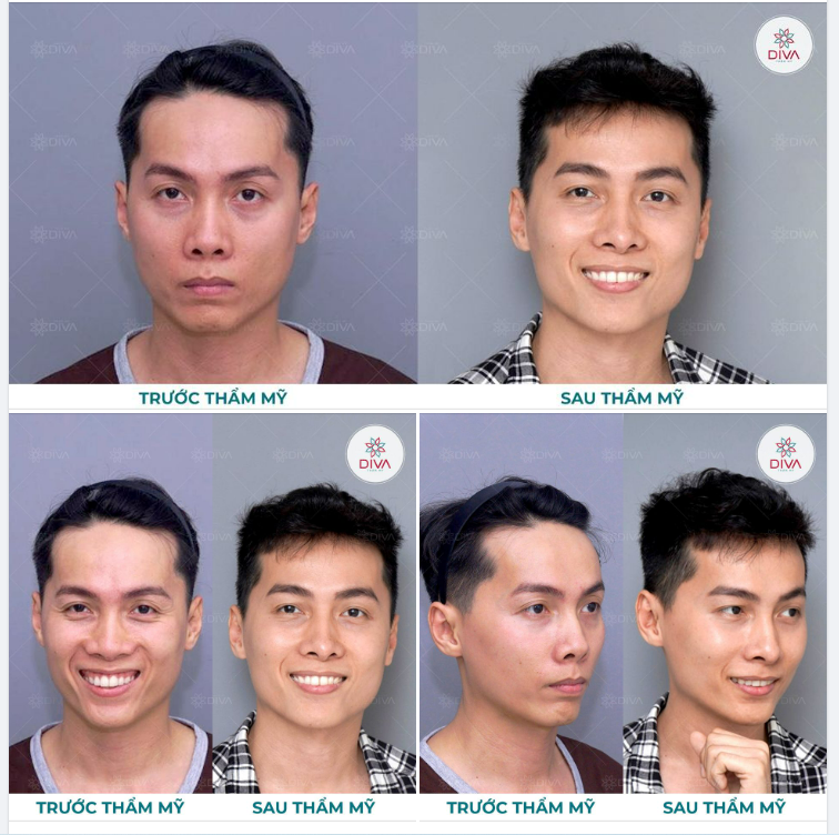 KẾT QUẢ THẨM MỸ GƯƠNG MẶC HỐC HÁC, GIÀ NUA SAU THẨM MỸ THAY ĐỔI RA SAO