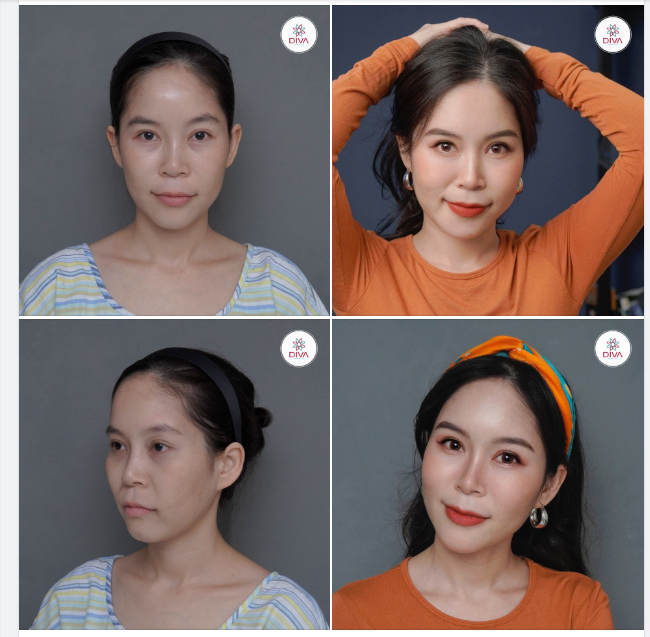 KẾT QUẢ THẨM MỸ MẶT BABY – TRẺ TRUNG DA CĂNG MỊN SAU CẤY MỠ COLEMAN + TIÊM PROFHILO