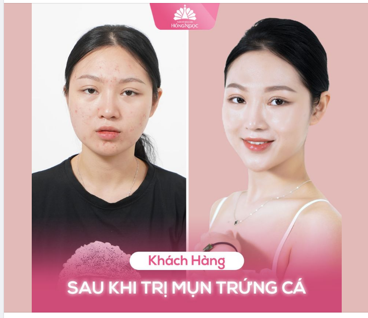 KẾT QUẢ TRỊ MỤN SAU 1 LIỆU TRÌNH ACNE MEDIC
