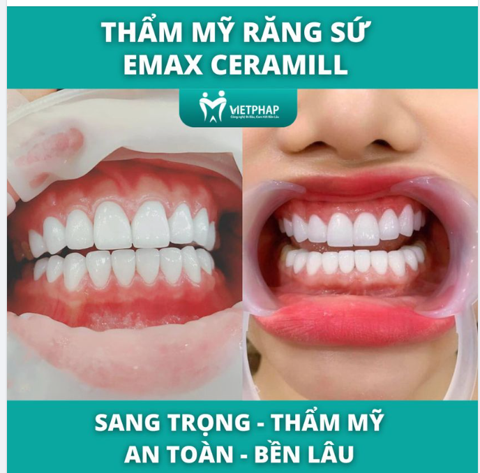 KẾT THÚC QUÁ TRÌNH BỌC RĂNG SỨ, SỰ HỒI HỘP THẤY RÕ TRÊN KHUÔN MẶT CỦA KHÁCH HÀNG