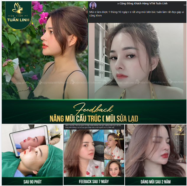 KH feedback sau nâng mũi cấu trúc (sửa lại) tại Tuấn Linh