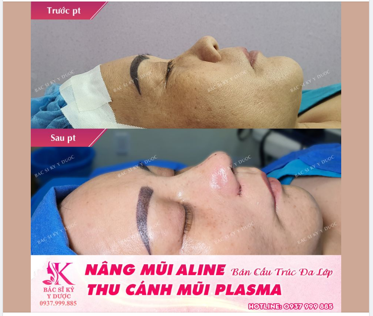 KHẮC PHỤC DÁNG MŨI THẤP + HẾCH CHỈ SAU 45 PHÚT - NÂNG MŨI ALINE CẤU TRÚC HAI LỚP + THU CÁNH