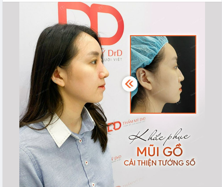 KHẮC PHỤC MŨI GỒ - CẢI THIỆN PHONG THỦY