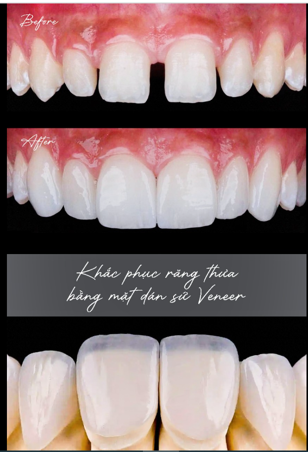 KHẮC PHỤC RĂNG THƯA BẰNG  MẶT DÁN SỨ VENEER