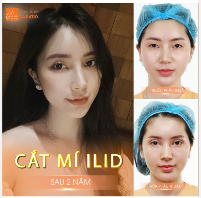 KHÁCH HÀNG NÓI GÌ VỀ CẮT MÍ ILID