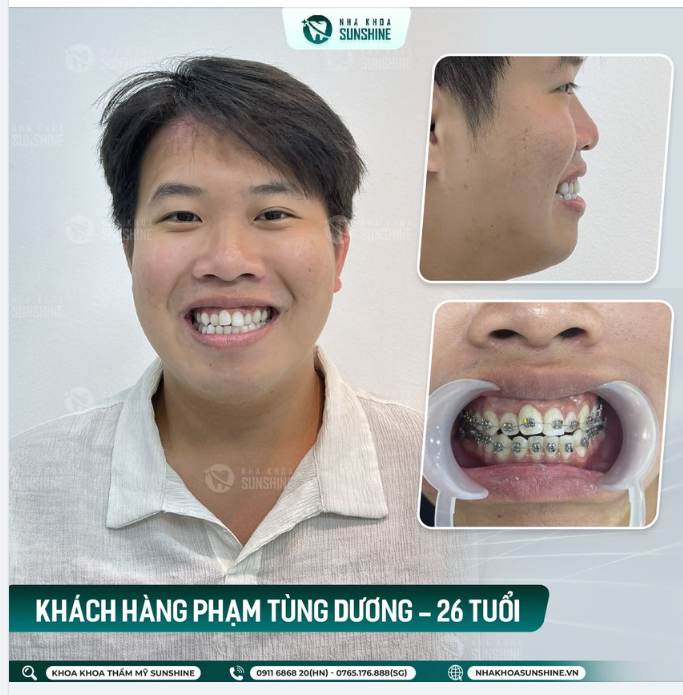 KHÁCH HÀNG PHẠM TÙNG DƯƠNG NIỀNG RĂNG TẠI SUNSHINE