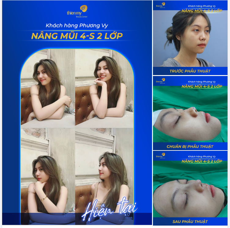 Khách hàng Phương Vy trải nghiệm phương pháp nâng mũi 4-S 2 lớp