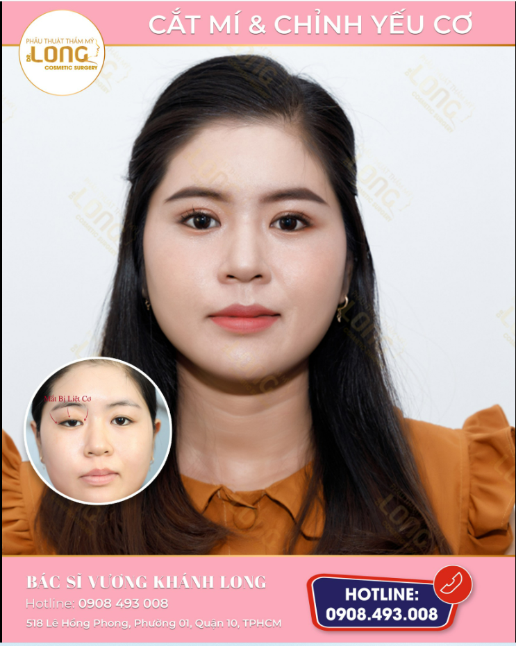 Khách hàng sau cắt mí