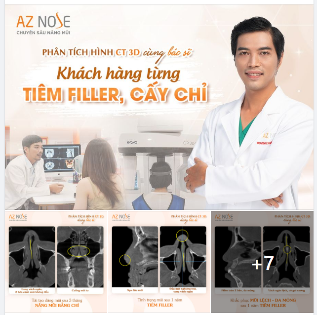 Khách hàng từng nâng mũi chỉ và t.iêm filler