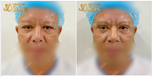Khi đàn ông đi cắt mí, kết quả sẽ như thế nào
