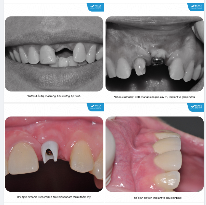 Khi nào bác sĩ chỉ định  ghép xương trong cấy ghép implant
