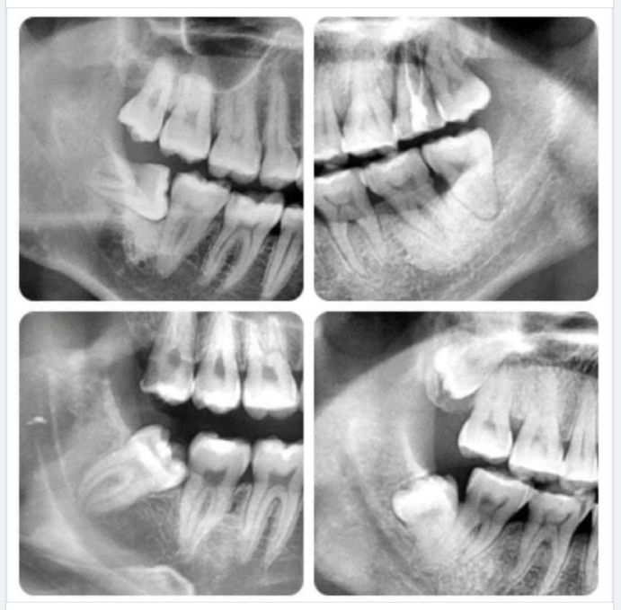 KHI NÀO BẠN CẦN NHỔ RĂNG KHÔN?