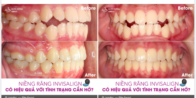 KHI NIỀNG RĂNG TRONG SUỐT ĐIỀU TRỊ CẮN HỞ