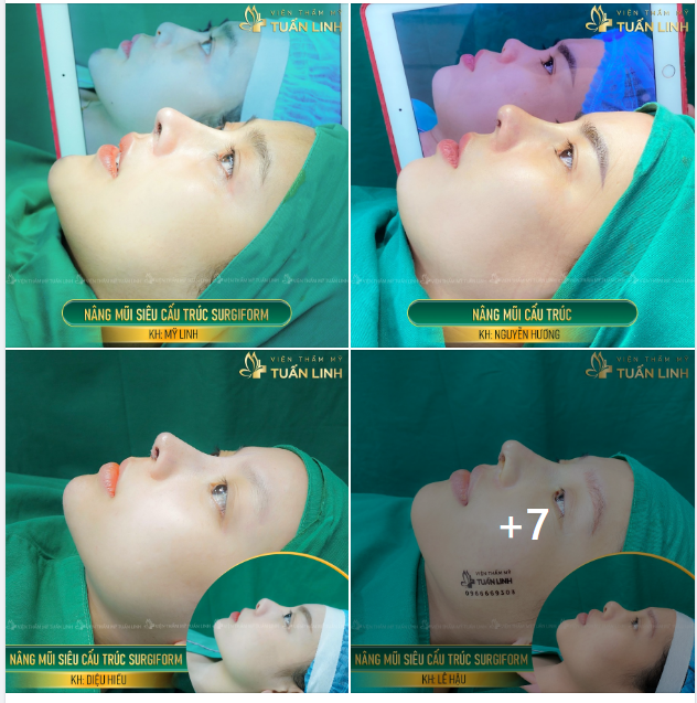 KHOE ''NHẸ'' 20 CA NÂNG MŨI TRONG NGÀY