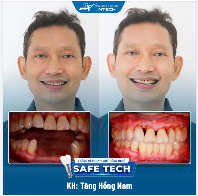 KHÔI PHỤC CHỨC NĂNG THẨM MỸ VÀ ĂN NHAI SAU KHI TRỒNG RĂNG IMPLANT CÔNG NGHỆ SAFE-TECH