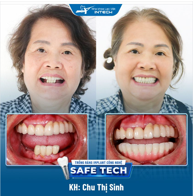 KHÔI PHỤC MẤT RĂNG TOÀN HÀM DƯỚI BẰNG PHƯƠNG PHÁP CẤY GHÉP IMPLANT