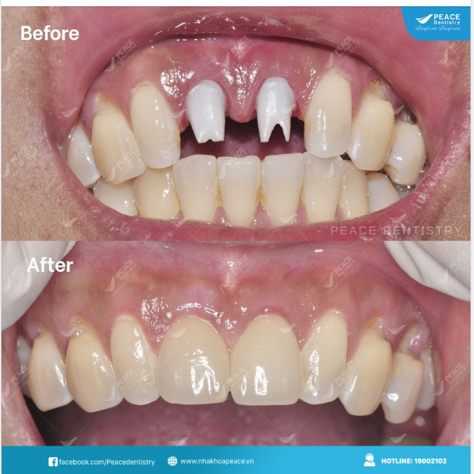 Khôi phục trọn vẹn sức nhai và thẩm mỹ với cấy ghép Implant!