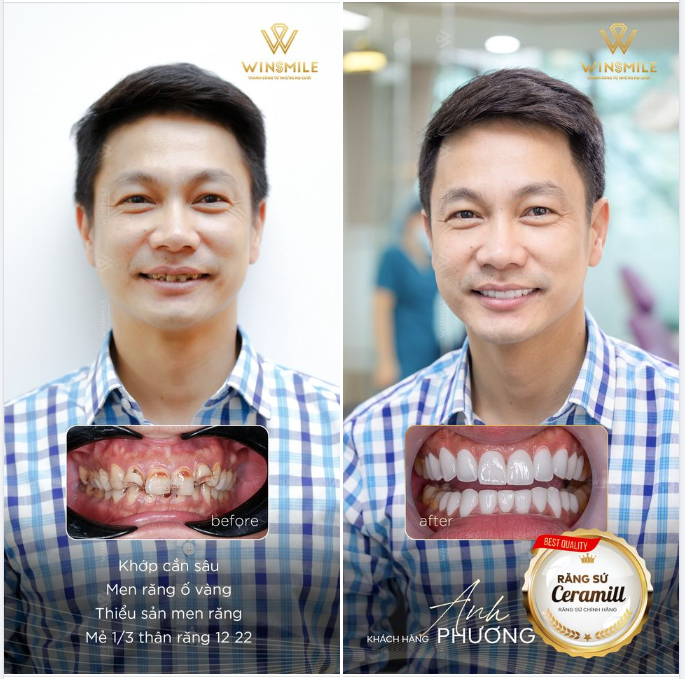 KHÔNG CÓ CA RĂNG KHÓ, CHI CẦN ĐẾN WIN SMILE LÀ ĐẸP