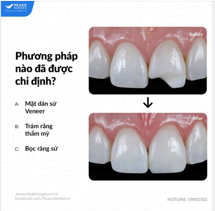 KHÔNG PHẢI MẶT DÁN SỨ VÀ KHÔNG PHẢI BỌC RĂNG SỨ