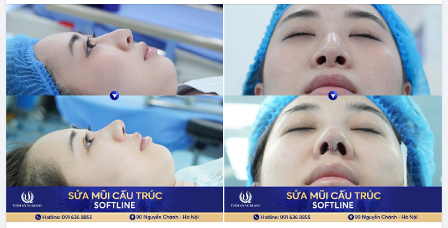 KHÔNG PHẢI NÂNG MŨI Ở ĐÂU CŨNG ĐẸP