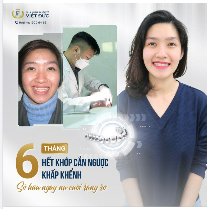 KHỚP CẮN NGƯỢC - NIỀNG RĂNG CÀNG SỚM