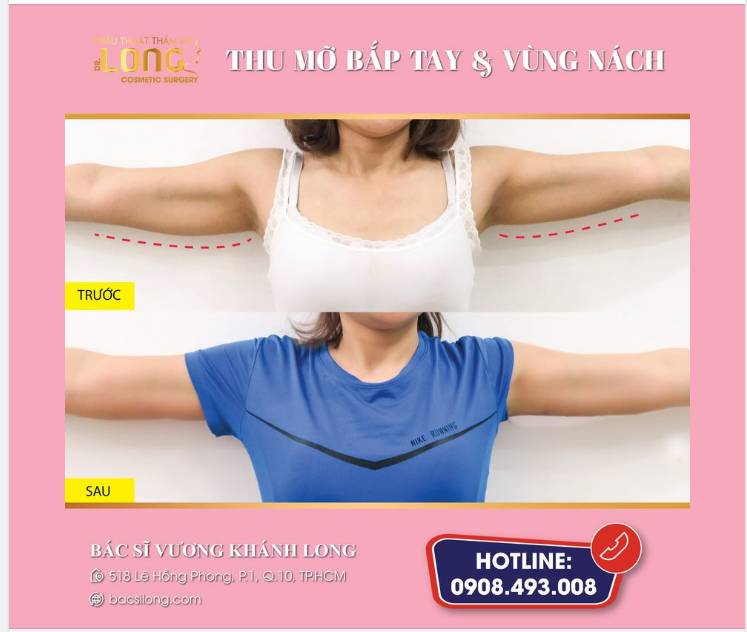 Là phụ nữ chẳng ai mong muốn có bắp tay to nhiều m.ỡ thừa kém săn chắc