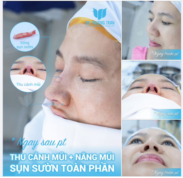 LẠI LÀ SỬA LẠI MŨI CHƯA ĐẠT TỪ NƠI KHÁC…