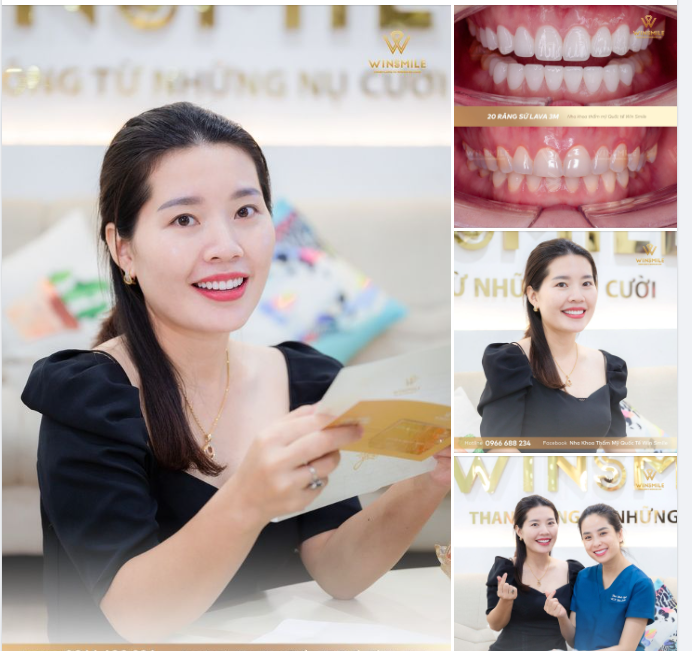 Lại thêm một vị khách kỹ tính nữa hoàn toàn bị chinh phục sau khi thẩm mỹ răng sứ tại Win Smile.