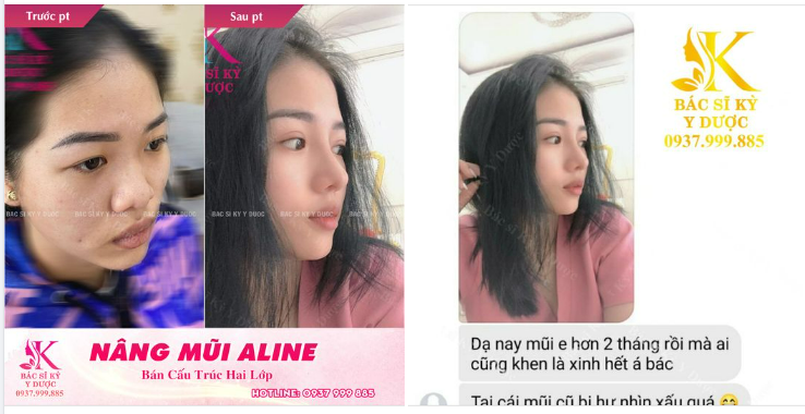 LÀM THẾ NÀO ĐỂ CÓ CHIẾC MŨI HOÀN HẢO MÀ KHÔNG CẦN PHẪU THUẬT
