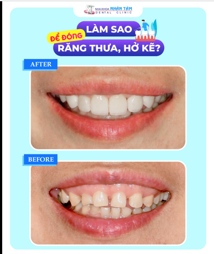 LÀM THẾ NÀO ĐỂ ĐÓNG RĂNG THƯA, HỞ KẼ?
