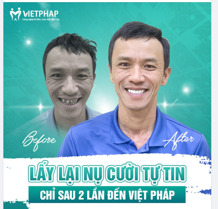 LẤY LẠI NỤ CƯỜI TỰ TIN CHỈ SAU 2 LẦN ĐẾN VIỆT PHÁP