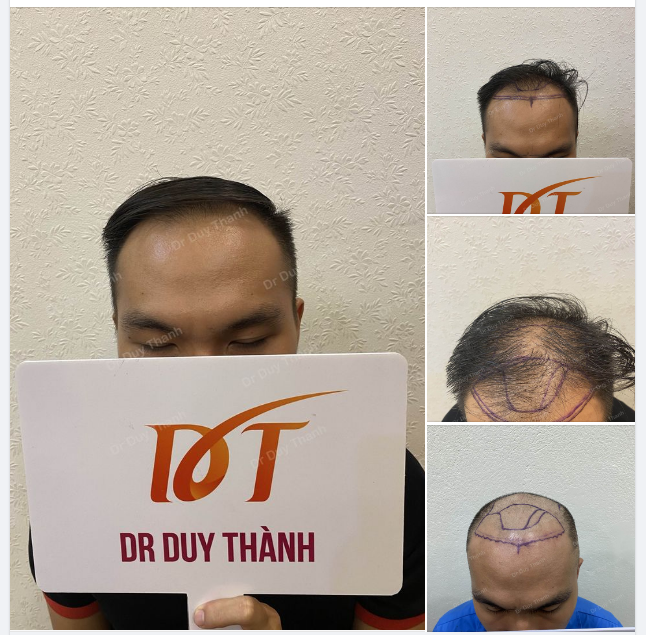 LÊN KẾ HOẠCH CẤY 2000 NANG PHIÊN 1 CHO KHÁCH HÀNG NAM TỪ TP.HCM